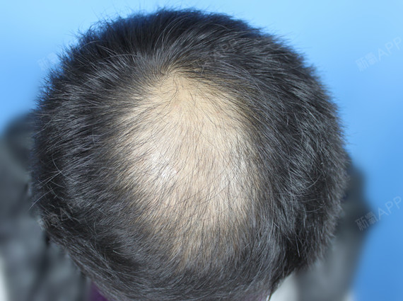 o型脱发,也可以说是秃顶性脱发,在中青年男性中已不