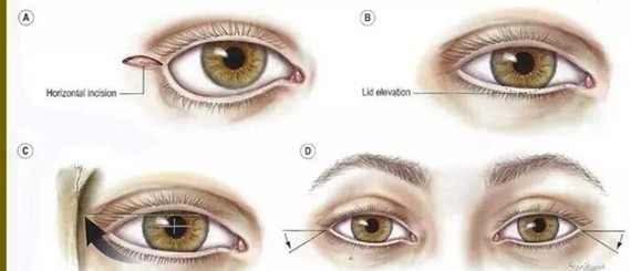 外眦除皱术参与面部年轻化整形
