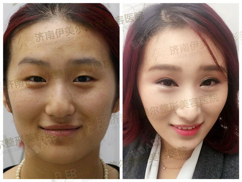 济南伊美尔"泉城美人计"第一季【眯眯眼的她,璀璨你_圈子-新氧美容