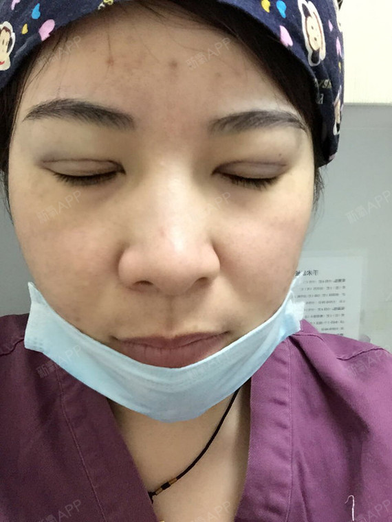 现在还能想起昨天做手术的时候,还非常的紧张,多亏是朱医生给我做