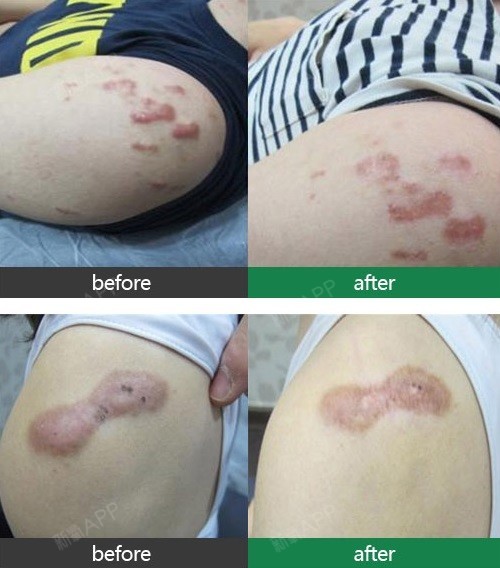 耳部 瘢痕疙瘩 疤痕 1 耳部瘢痕疙瘩 耳 圈子 新氧美容整形