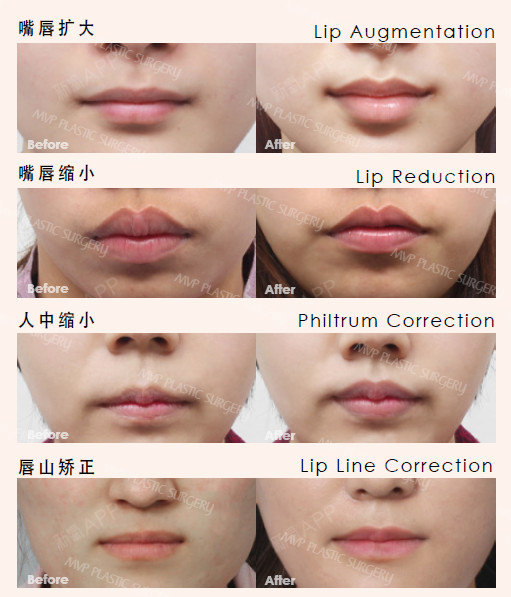 韩国mvp整形医院的嘴唇整形