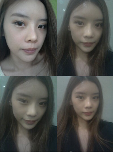 新氧- m小护士m | 术后当自强 | 下颌骨整形术