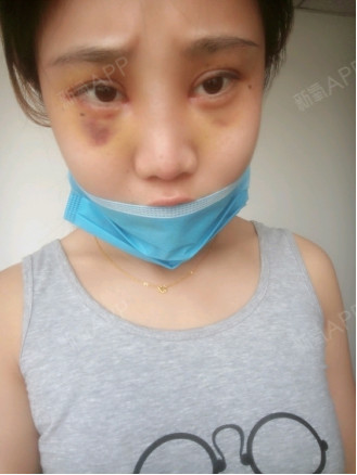 症状: 满意度: 肿胀度: 疼痛感: 疤痕度: b1313v2 e 2016-01-12 21:31