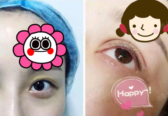 今天早上感觉还不错,恢复的很块[:30],,_圈子-新氧美容整形