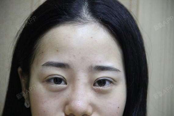 我一直贴双眼皮贴眼皮都松弛了~眼角下垂,看起来一副_圈子-新氧美容