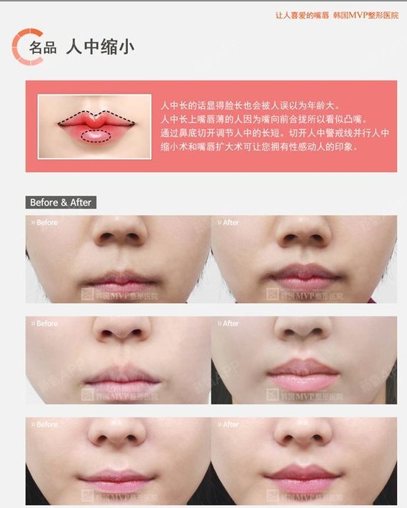 人中也能缩小?韩国mvp整形外科医院最近_圈子-新氧美容整形