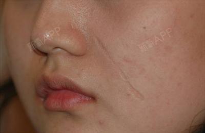 w-形整形术可以调整疤痕与皮肤纹理