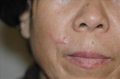 【艾源整形外科真实案例翻译】-脸部疤痕修复-我们或_圈子-新氧美容