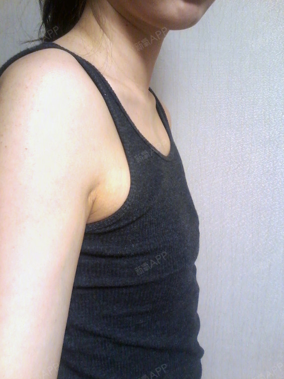 我就是你的维c假体隆胸术后第93天美丽日记_新氧整形