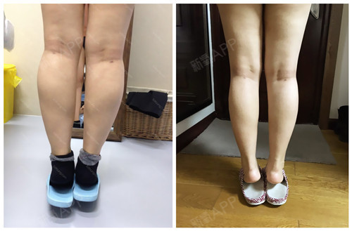 肉毒素瘦小腿14天