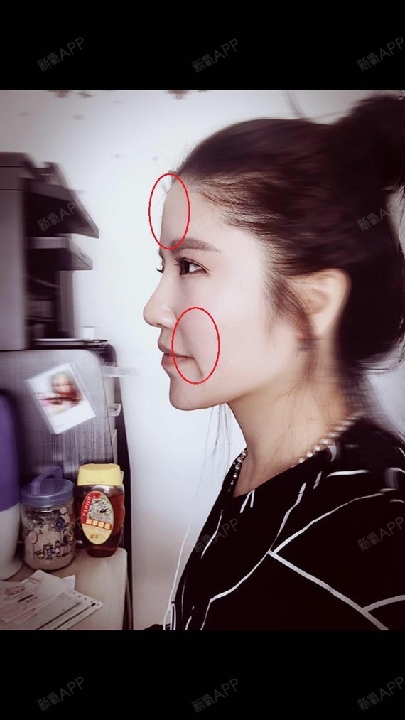 新氧- 大芒果 | 术后当自强 | 自体脂肪填充额头