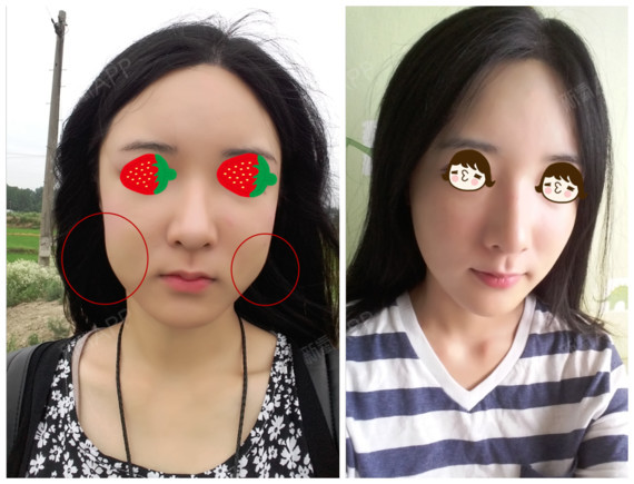 那木整形外科皮肤科去颊脂垫手术术后一个月后记