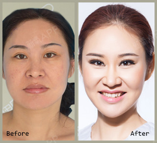 梅子andy切开双眼皮第311天美丽日记-新氧美容整形