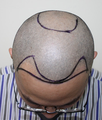 种植区已经画好范围,两个额角和头顶都需要种植