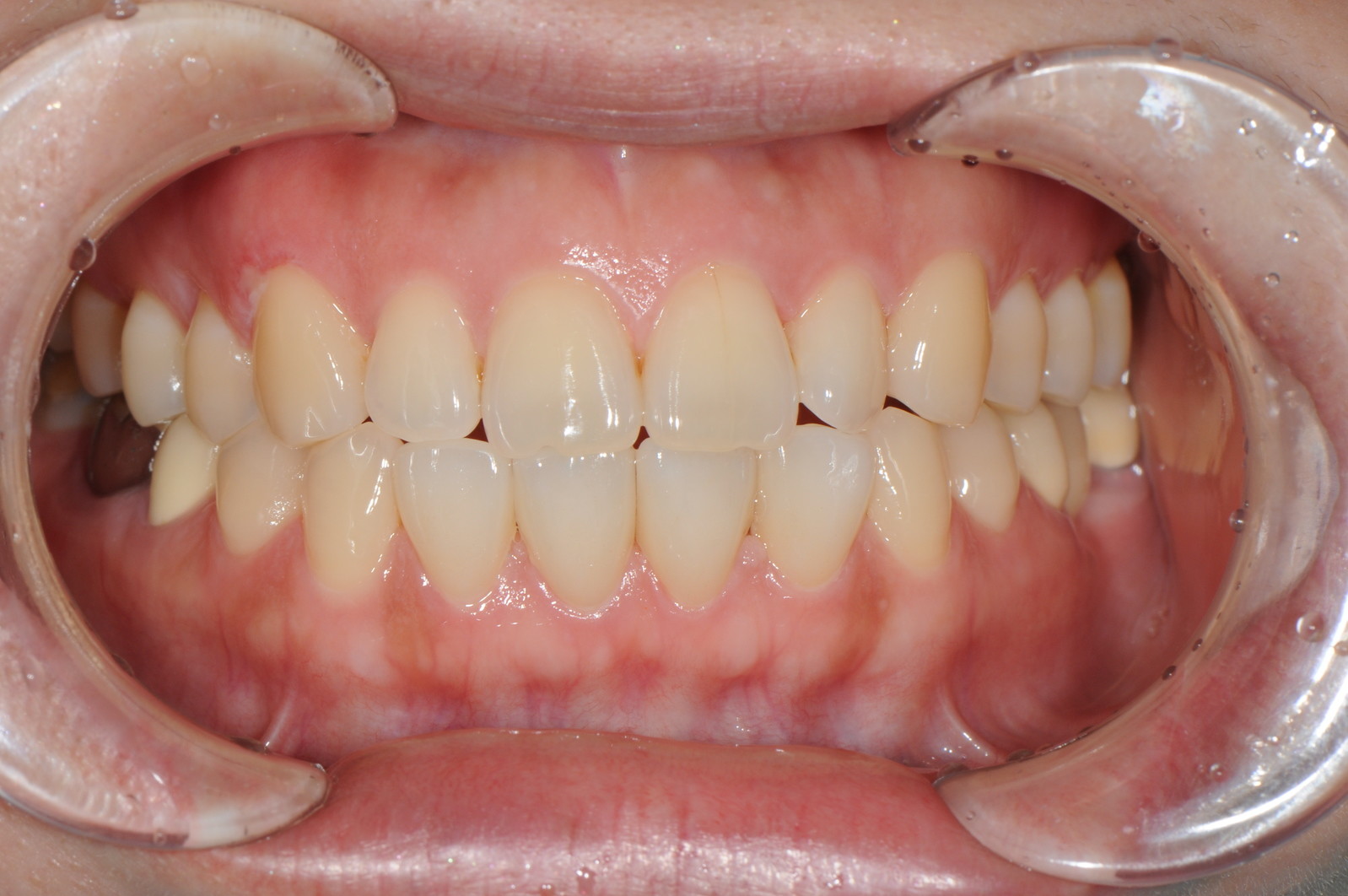 新氧- 北京合众齿科 | 术后当自强 | 烤瓷牙