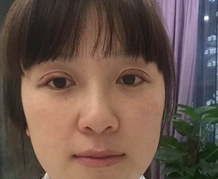 新氧- 木子于 | 术后当自强 | 韩式三点双眼皮