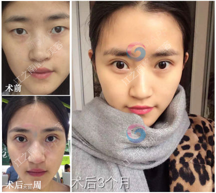 双眼皮做多宽最自然?