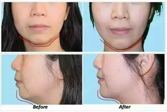 下巴适度地向前突(向前翘);2.颏颈角明显,3.下巴_圈子-新氧美容整形