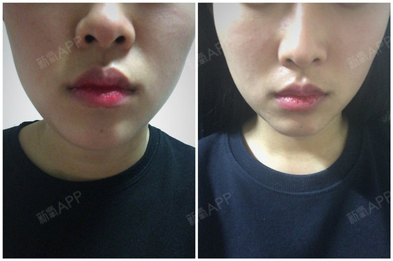 大家好~其实我已经打过两次轮廓针了,这次连着瘦脸针一起打的