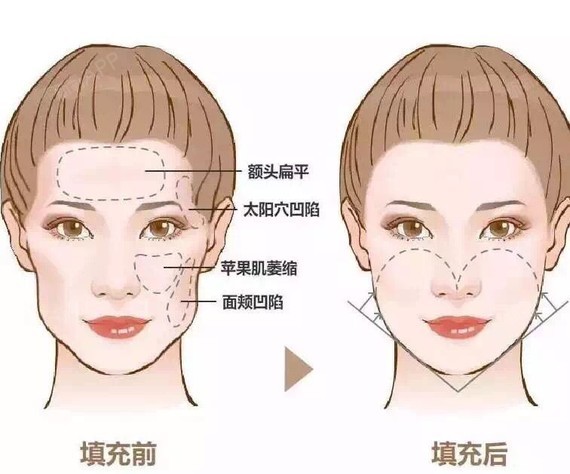 自体脂肪填充全脸