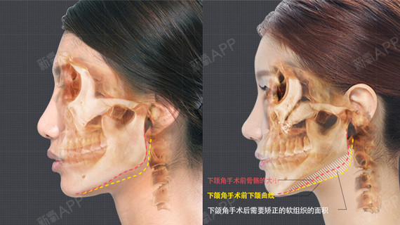 【面部骨骼手术后 需要矫正下垂面部的情况】
