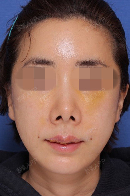 唇部手术#m唇唇珠第4天记录这位患者术前情况是,_圈子-新氧美容整形