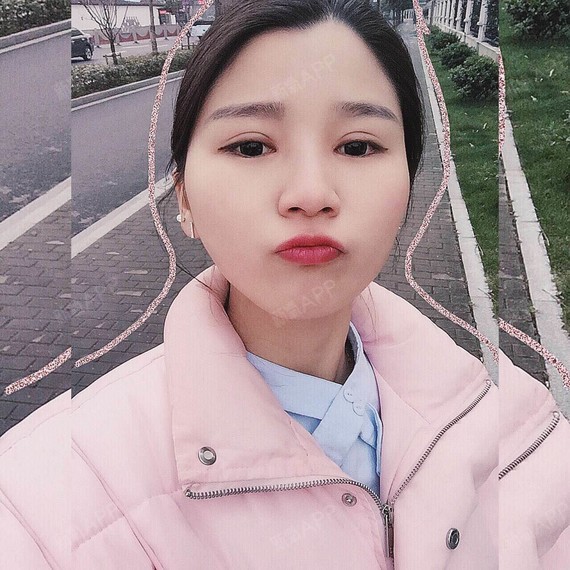 切开双眼皮好不好_效果图_筱筱酱切开双眼皮术后第91天_新氧美容整形