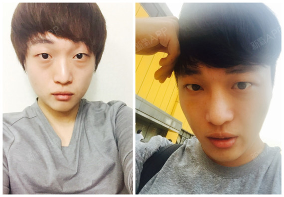 那木整形外科皮肤科男性整形眼部多项鼻部多项术后三个个月_圈子-新氧