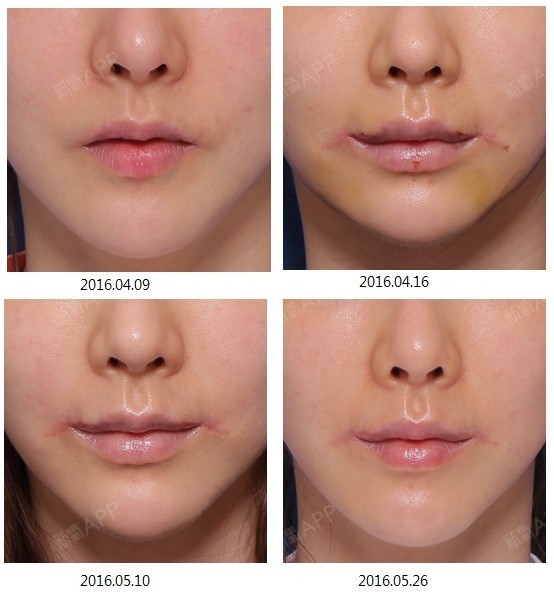 【唇部整形】【嘴角上提术】【微笑唇】韩国最早最据权_圈子-新氧美容