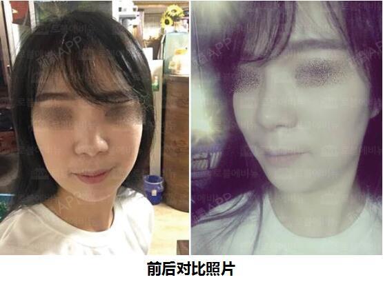 韩星进化论 雪莉退出f X 后从大象腿逆袭女神腿 圈子 新氧美容整形