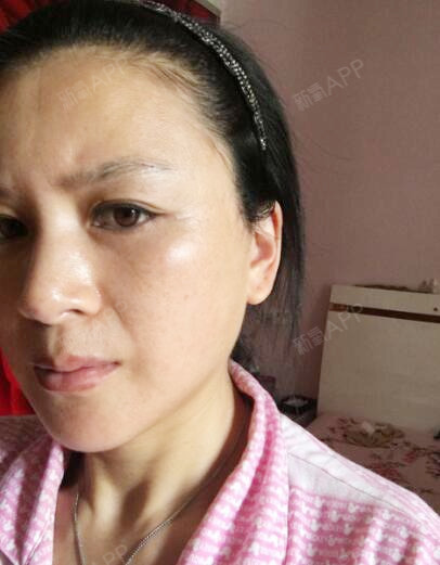 做完下面部拉皮手术差不多20天了还是有点肿胀现在也没吃消炎药了很