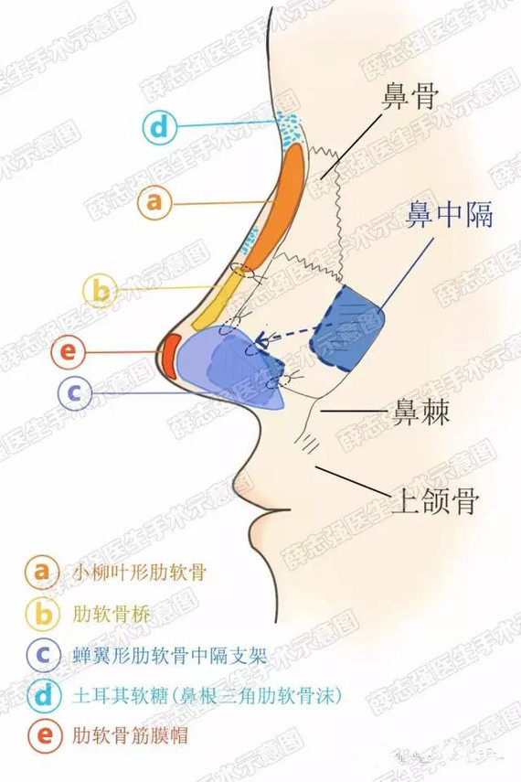鼻尖应当根据解剖学美学亚单位,进行立体化设计,综合调整鼻小柱,鼻翼