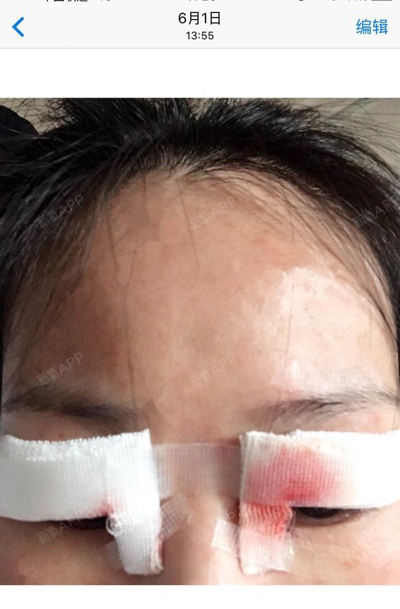 6月1号上午十点左右朋友陪同我到了燕塘大厦广美总院,术