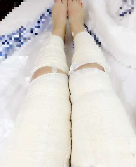 上海吸脂瘦小腿好不好_效果图_笔筒装花吸脂瘦小腿术后第7天_新氧美容