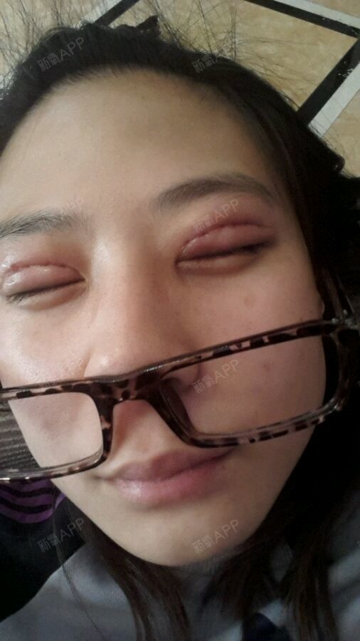 南京定点双眼皮好不好_效果图_二虹定点双眼皮术后第14天_新氧美容