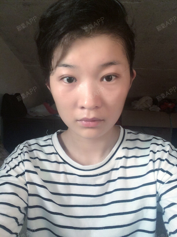 半个月时候的照片,一高一低,面部感觉都歪了,感觉好恐怖.