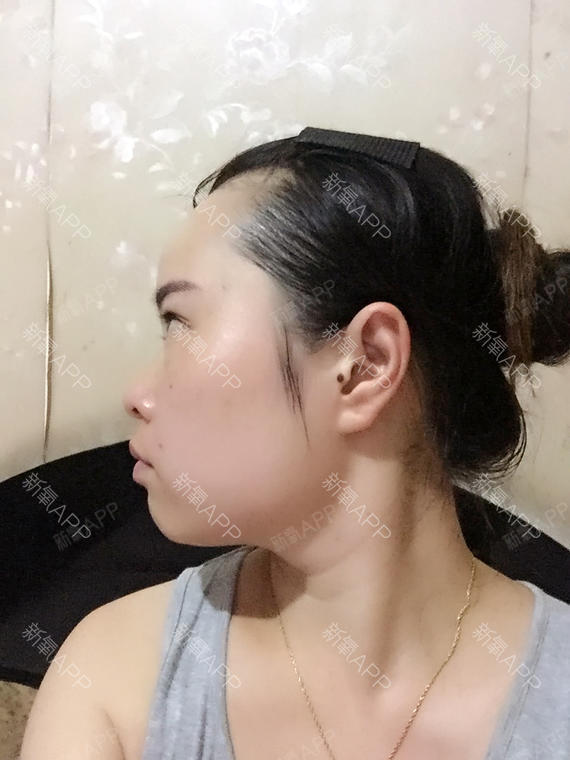 需要手术的理由:下颚角有些大但没有外翻加上咬肌下巴短形成了名副