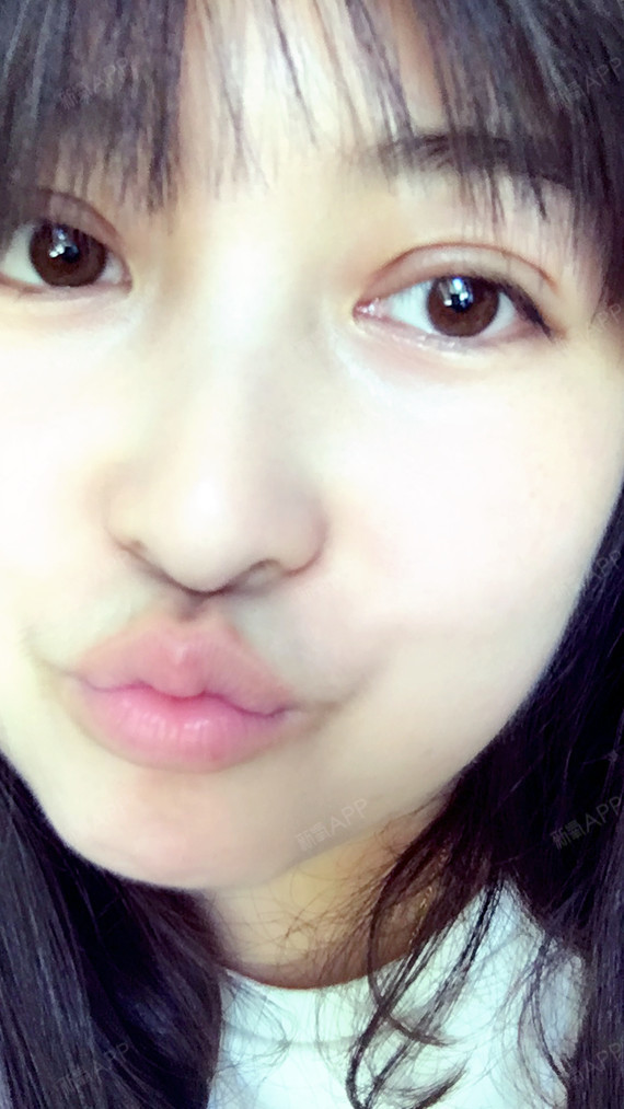 来更新了,今天是切开双眼皮第15天,嘿嘿,半个月了_圈子-新氧美容整形