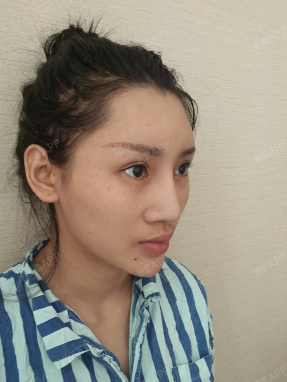 今天是打完溶解酶后第二天准备手术之前下巴