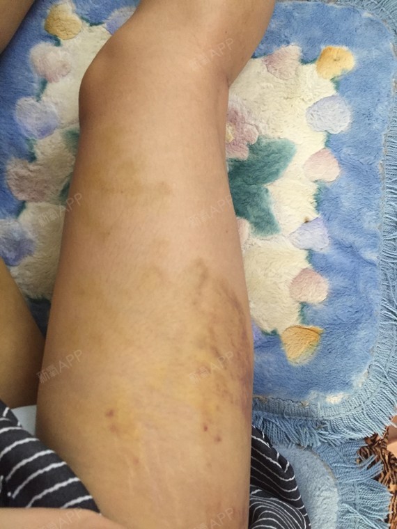 这是大腿外侧的样子,淤血只要热敷加适当按摩,感觉好的快一些