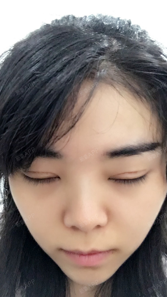 成都上眼睑去脂好不好_效果图_壹壹_951763上眼睑去脂术后第12天_新氧