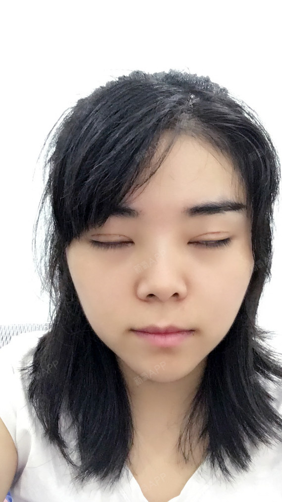 成都上眼睑去脂好不好_效果图_壹壹_951763上眼睑去脂术后第12天_新氧