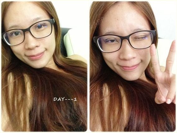 kellyyang埋线双眼皮术后第1天美丽日记_新氧整形