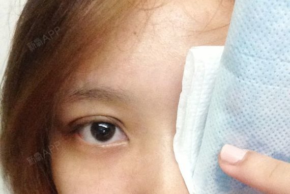 埋线双眼皮好不好_效果图_kellyyang埋线双眼皮术后第2天_新氧美容