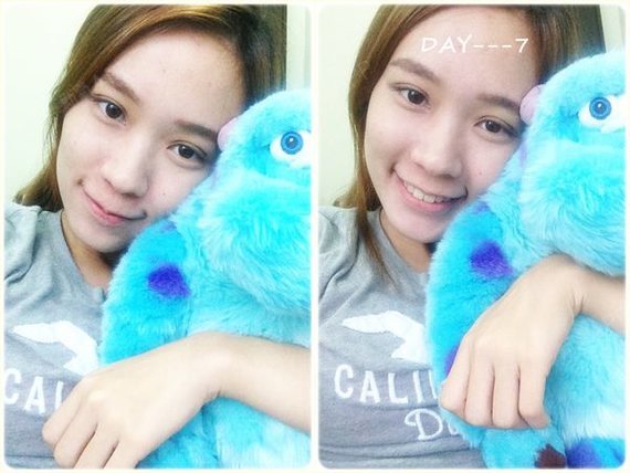 金华埋线双眼皮好不好_效果图_kellyyang埋线双眼皮术后第7天_新氧