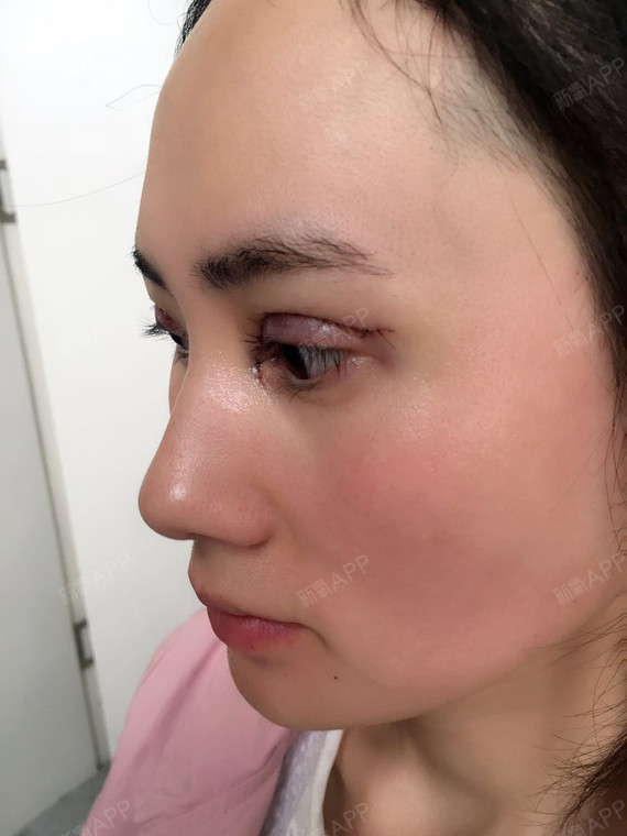 昨天,9月13号,我完成了人生中的一件大事,割双眼_圈子-新氧美容整形