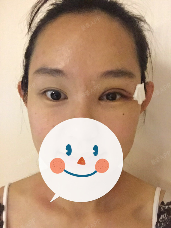 上周在徐晓斐那做的单侧上睑下垂矫正和提肌.