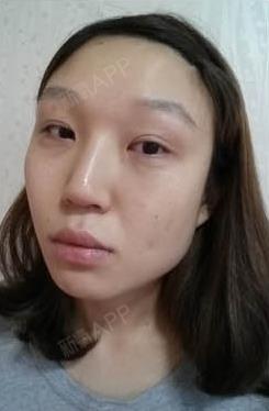 我在巴诺巴奇做的颜面轮廓手术,之前,因为我大又