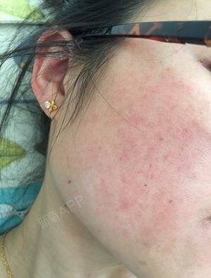 新氧- 绿色森林 | 激光脱毛 | 术后当自强 | 脱大小腿